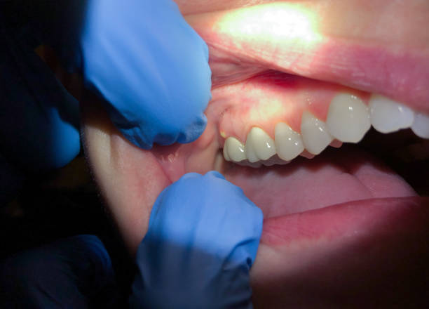 Best Knocked-Out Tooth Emergency  in Oli, PA